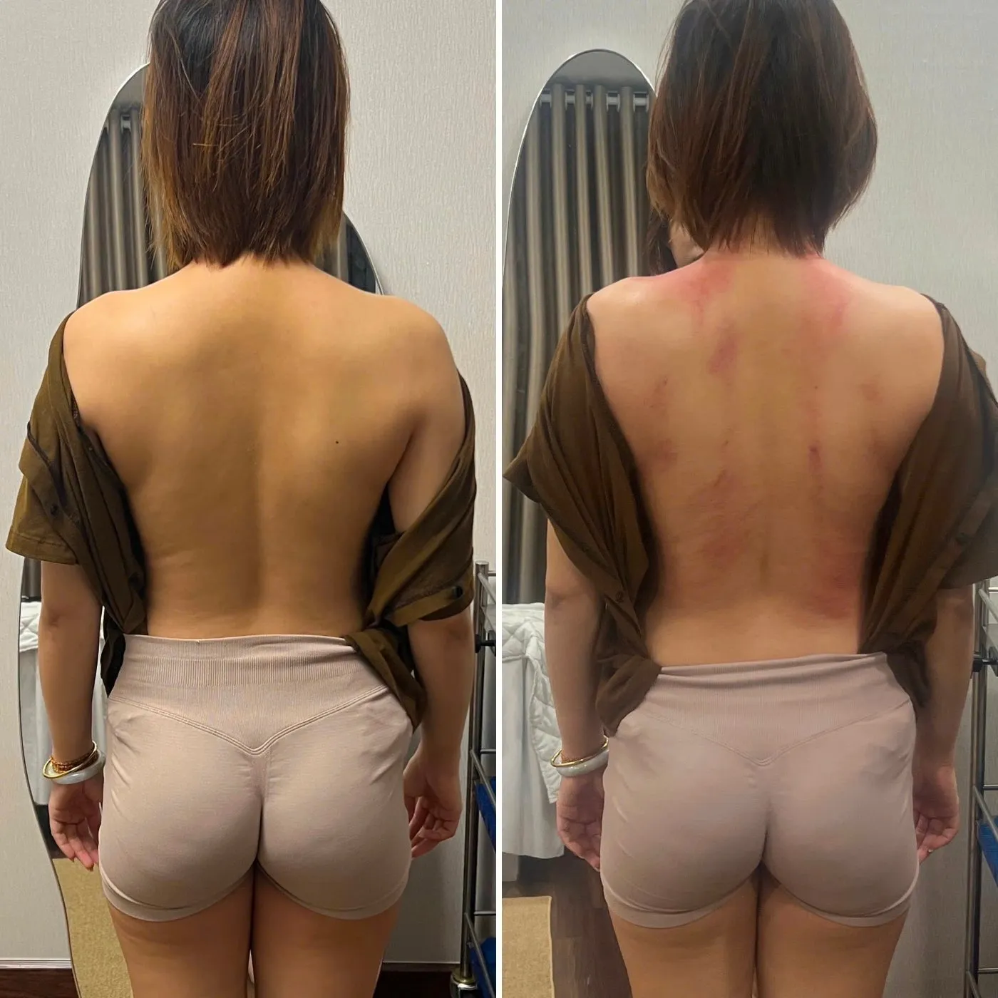 Vùng vai gáy và bả vai của khách nữ, trước và sau buổi trị liệu tại AN