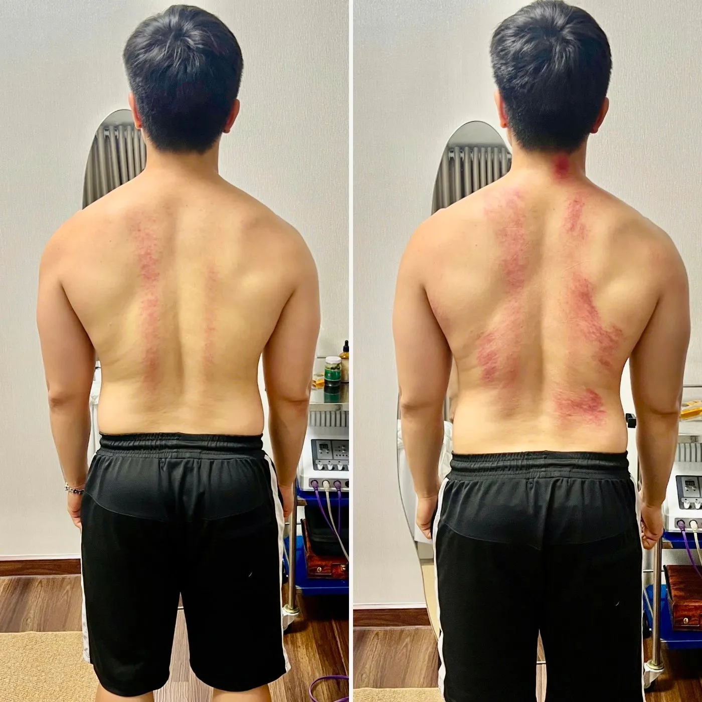 Hai bên cột sống của khách nam, trước và sau buổi trị liệu tại AN